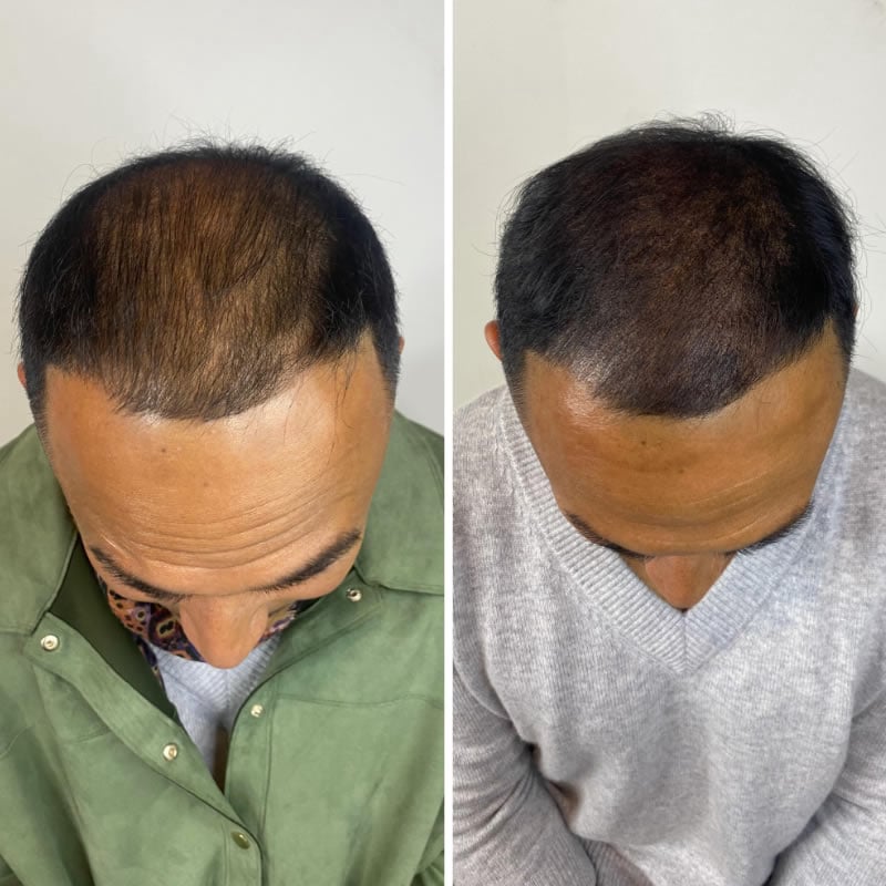 Scalp Micropigmentation near me